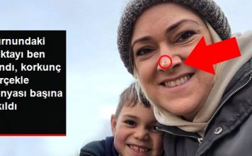 Burnunun ucunda çıkan noktayı ben sanmıştı! Gerçeği öğrenince dünyası başına yıkıldı